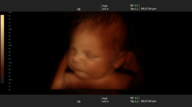 Ultrasound photo of a fetus