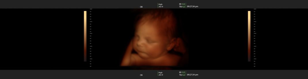 Ultrasound photo of a fetus